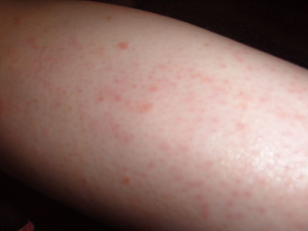 red irritated skin after waxing