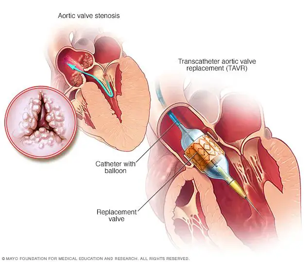 heart valve replacement surgery